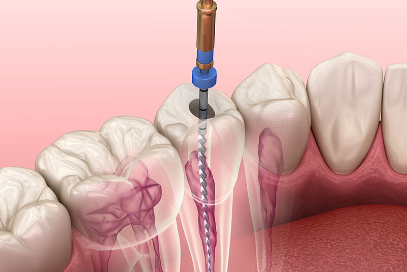 Root canal illustration