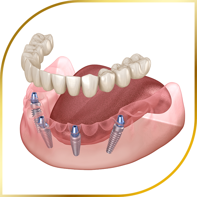 Illustration of a full-arch dental implant with four implants supporting a fixed denture in the lower jaw.