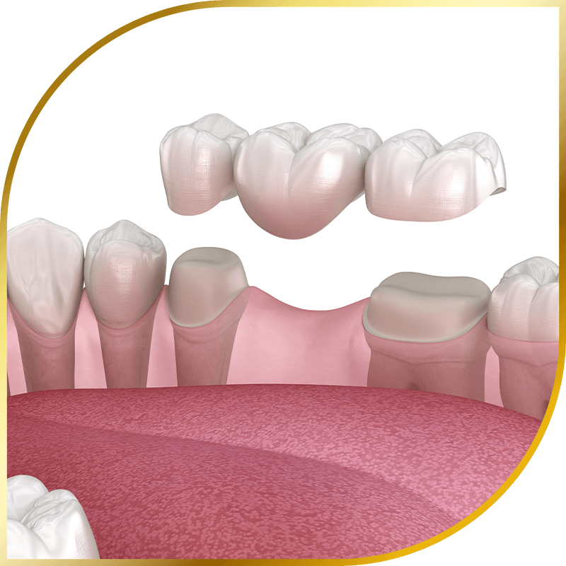 Dental bridge model
