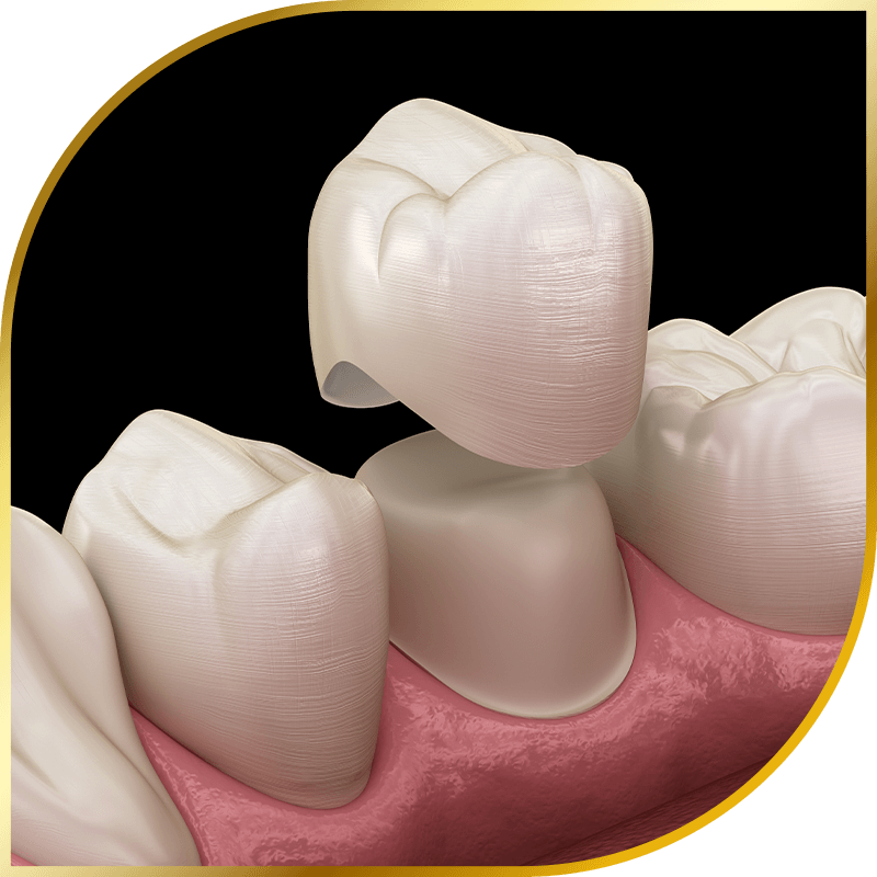 Dental crown restoration