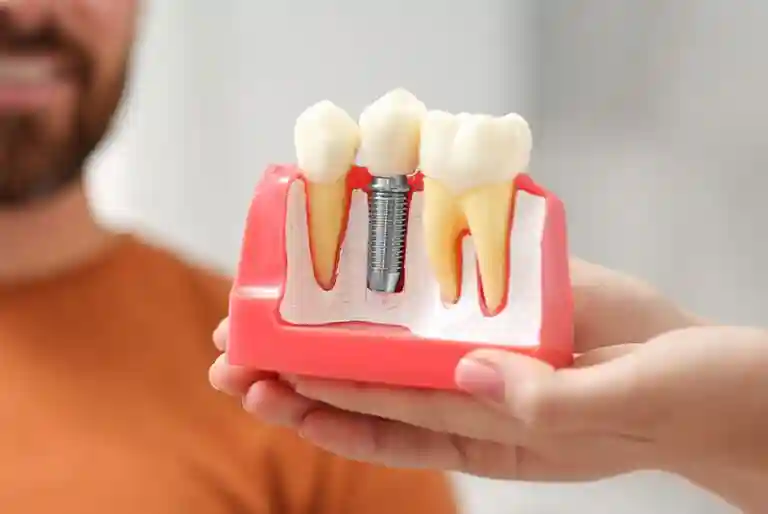 dentalimplantmodel-768x514-1